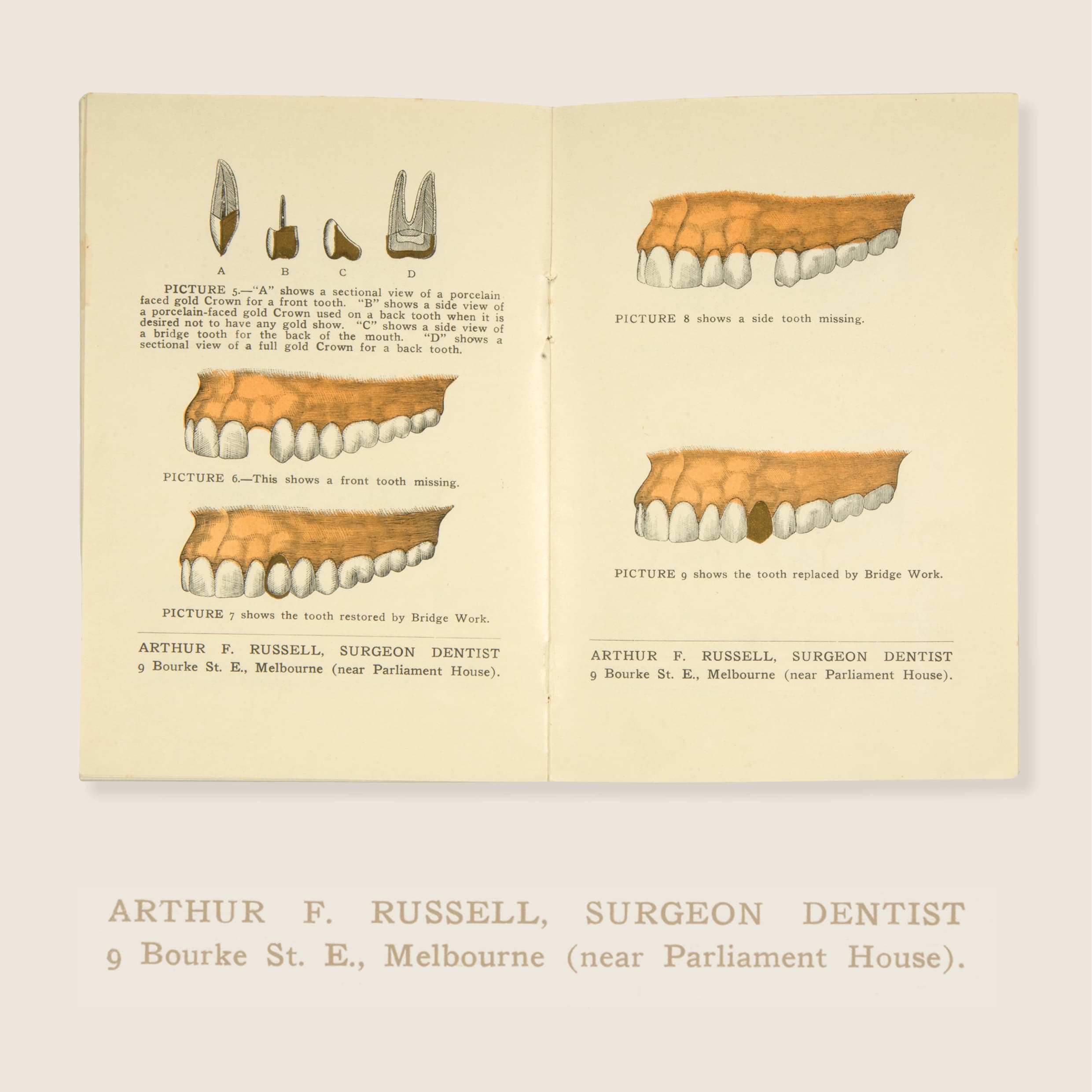 Arthur F Russell (1864–1915), Dental bridge work to-day, Melbourne: Renwick, Pride & Nuttall (printer), c. 1910s, paper, ink, 17.4 × 12.0 cm. HFADM 2781, gift of Mrs Newton, Henry Forman Atkinson Dental Museum, University of Melbourne.