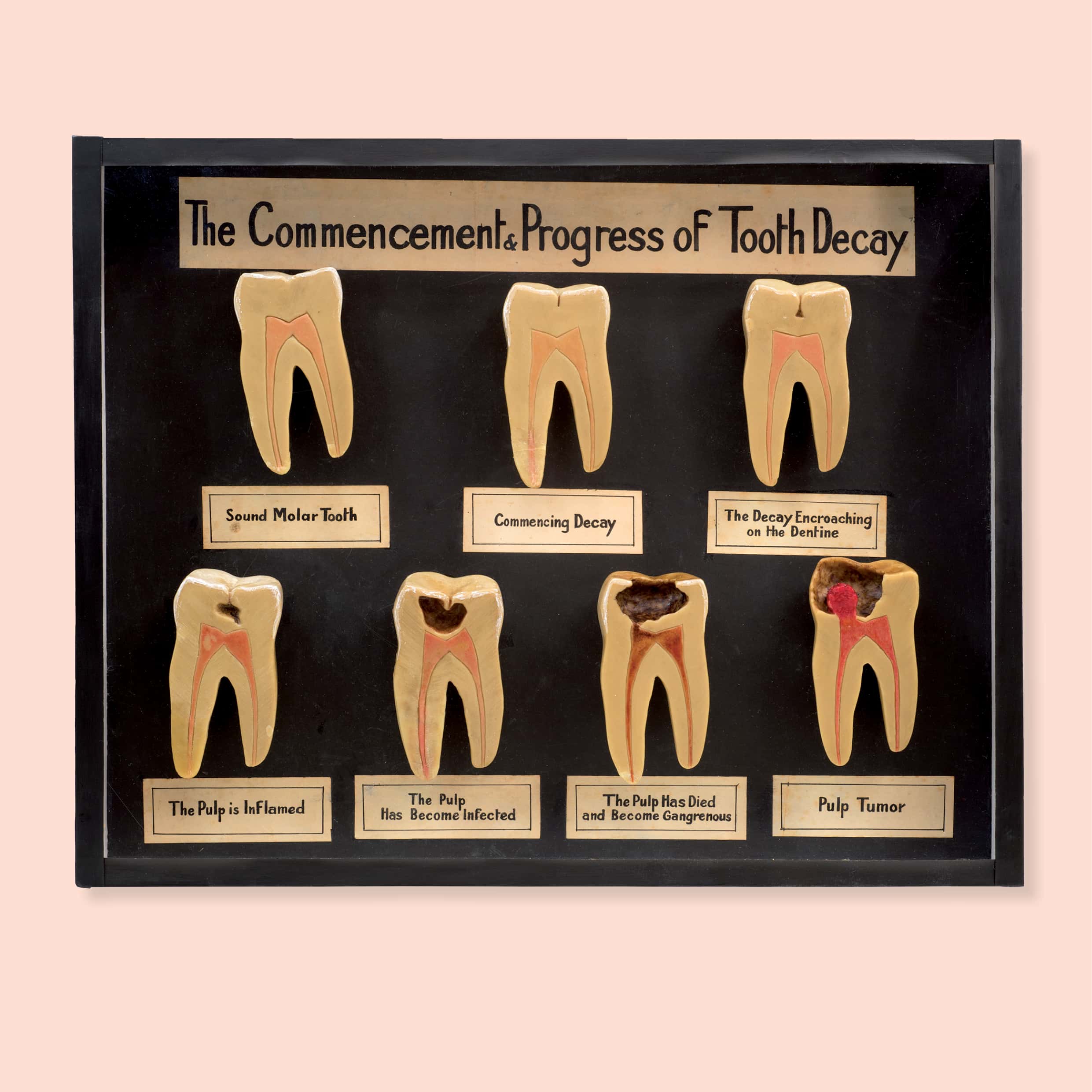 Charles Harold Down (1890–1965), Molar models in case: The commencement & progress of tooth decay, c. 1930, wax, paint, paper, ink, wood, glass; 40.0 × 50.5 × 6.0 cm. HFADM 2574, gift of the Australian College of Dentistry 1963, Henry Forman Atkinson Dental Museum, University of Melbourne. 