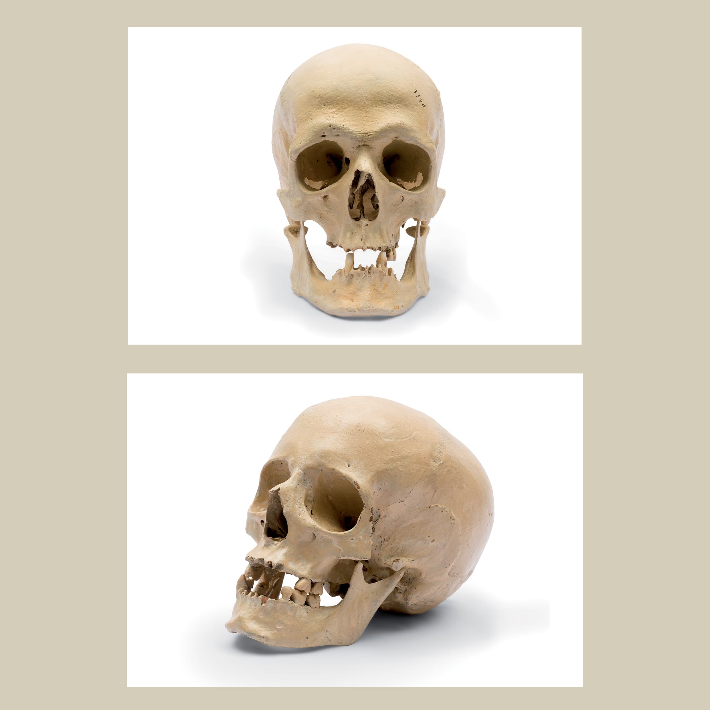 <strong>Skull of Frances Lydia Alice Knorr</strong> (1868–1894), human skull, skull and upper jaw 15.0 × 13.5 × 19.0 cm; lower jaw 6.3 × 11.5 × 10.0 cm. HFA Teaching Collection 3091, gift of the National Trust of Australia (Victoria) to the Melbourne Dental School, University of Melbourne, 2006.<br><br><strong>Skull of Martha Needle</strong> (1863–1894), human skull, 15.5 × 13.0 × 22.3 cm. HFA Teaching Collection 3093, gift of the National Trust of Australia (Victoria) to the Melbourne Dental School, University of Melbourne, 2006.